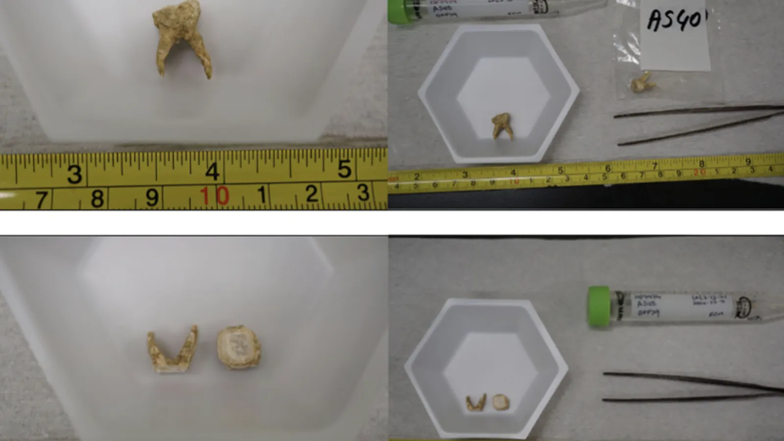 a tooth from human remains found outside of modern Istanbul in which scientists detected aDNA (ancient DNA) from Yersinia pestis, the bacterium that causes plague